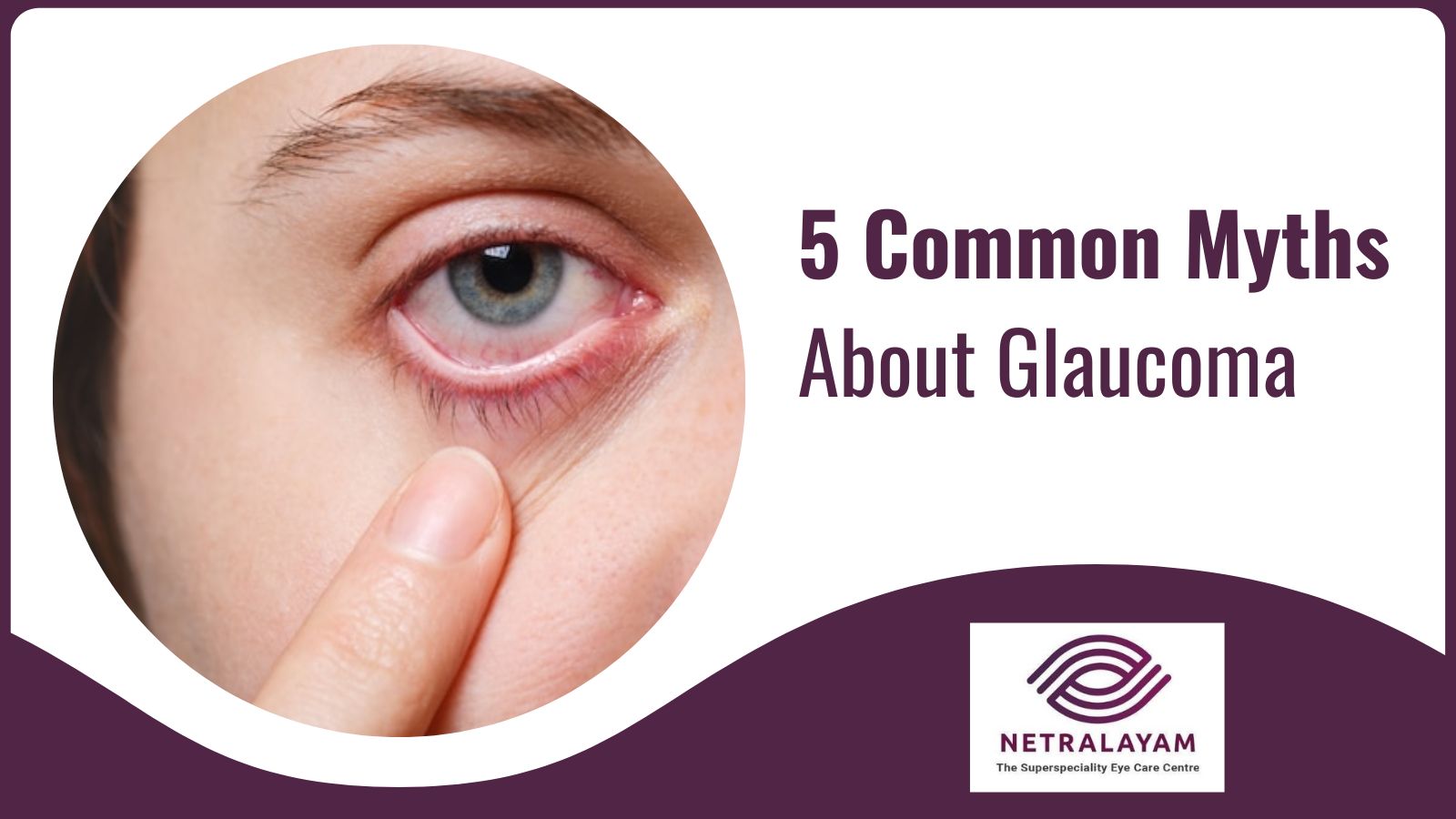 5 Common Myths About Glaucoma