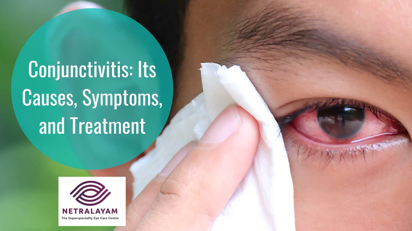 Conjunctivitis Its Causes Symptoms And Treatment