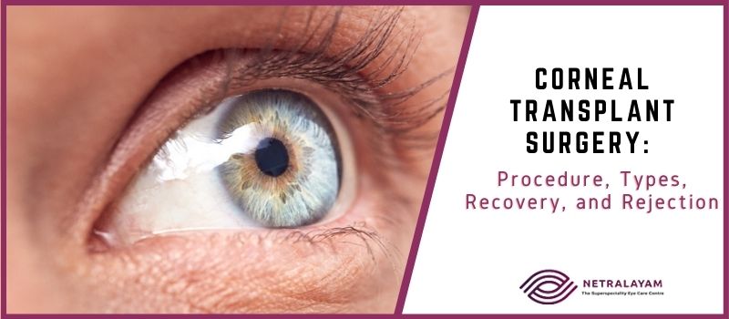 Corneal Transplant Surgery: Procedure, Types, Recovery, and Rejection