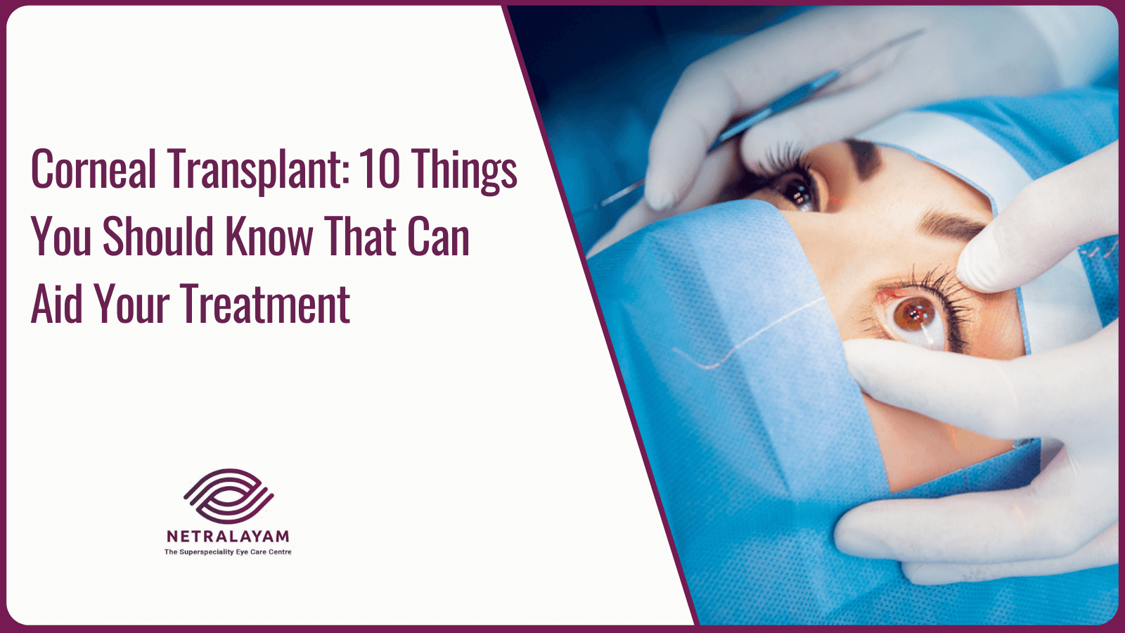 Corneal Transplant: 10 Things You Should Know That Can Aid Your Treatment