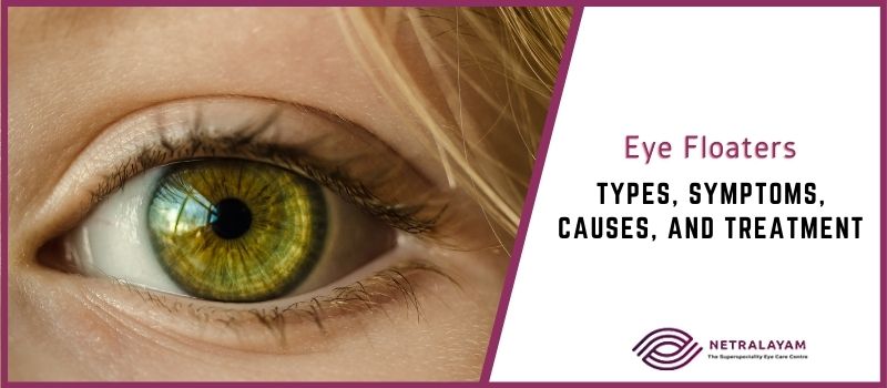 Eye Floaters – Types, Symptoms, Causes, and Treatment
