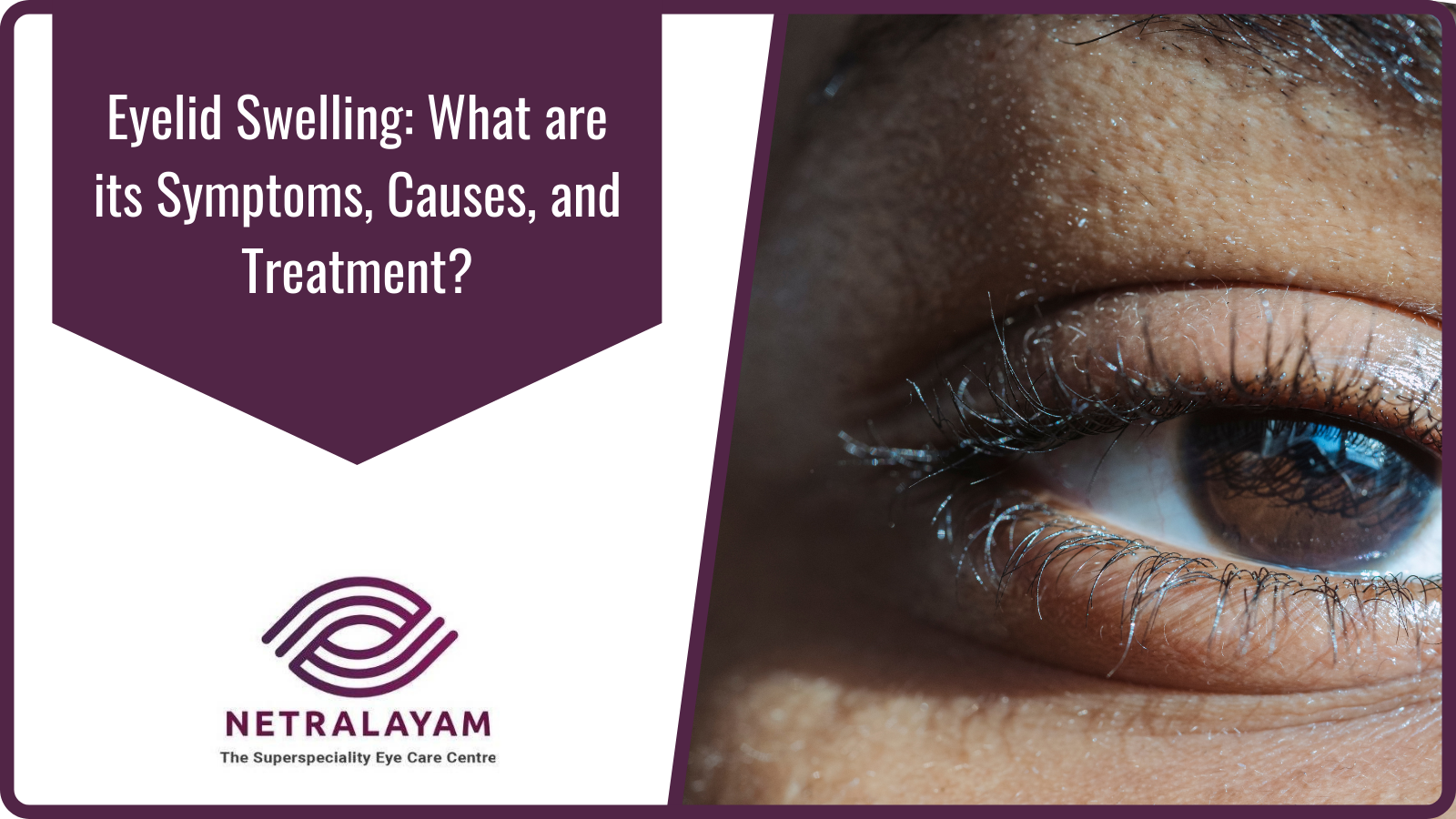 Eyelid Swelling: What are its Symptoms, Causes, and Treatment?
