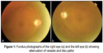 Fundus photographs of the right eye and the left eye showing attenuation of vessels and disc pillar