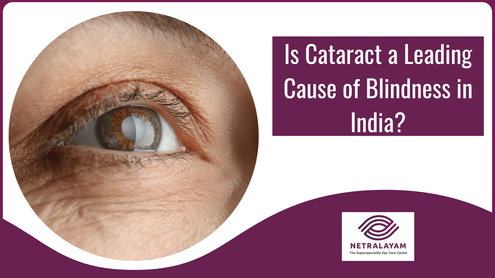 Is Cataract a Leading Cause of Blindness in India?