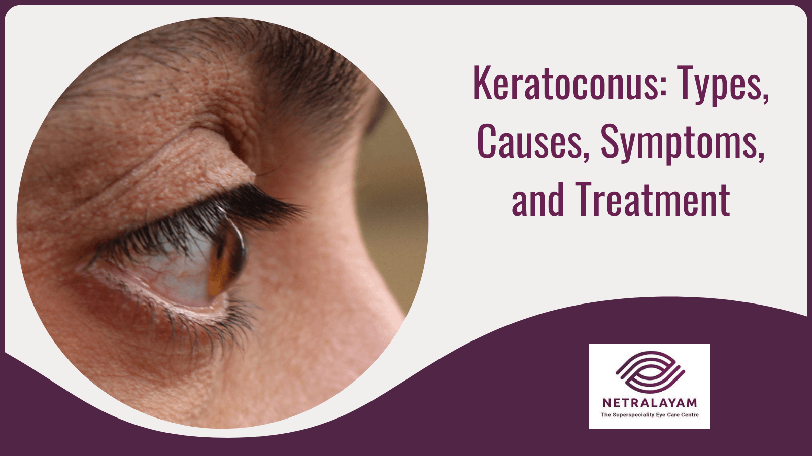 Keratoconus: Types, Causes, Symptoms, and Treatment