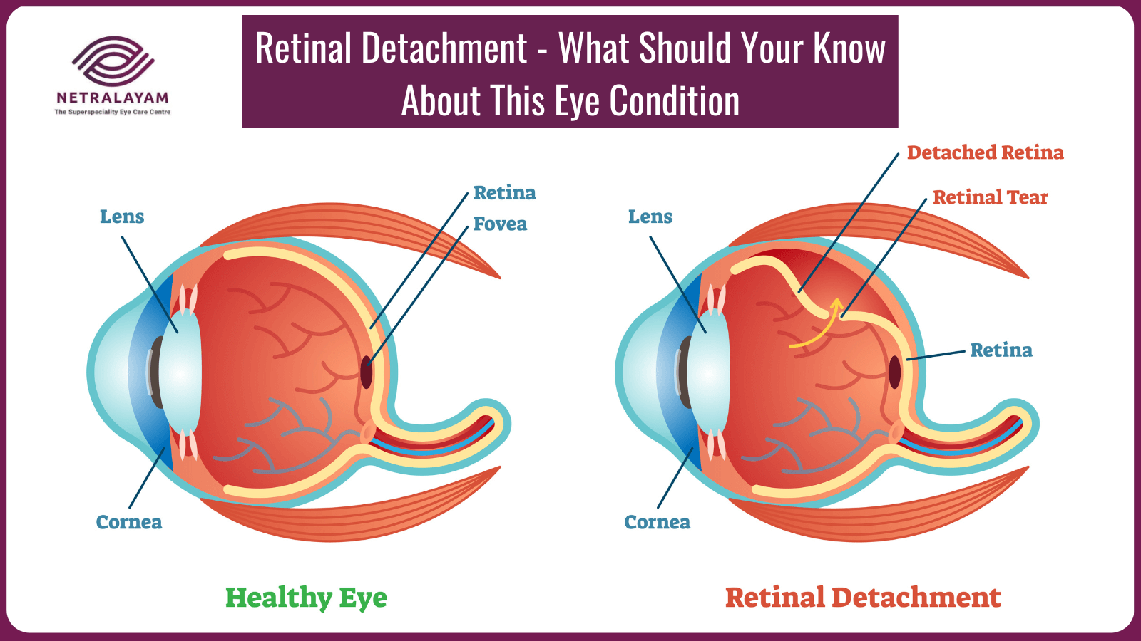 Retinal Detachment - What Should Your Know About This Eye Condition