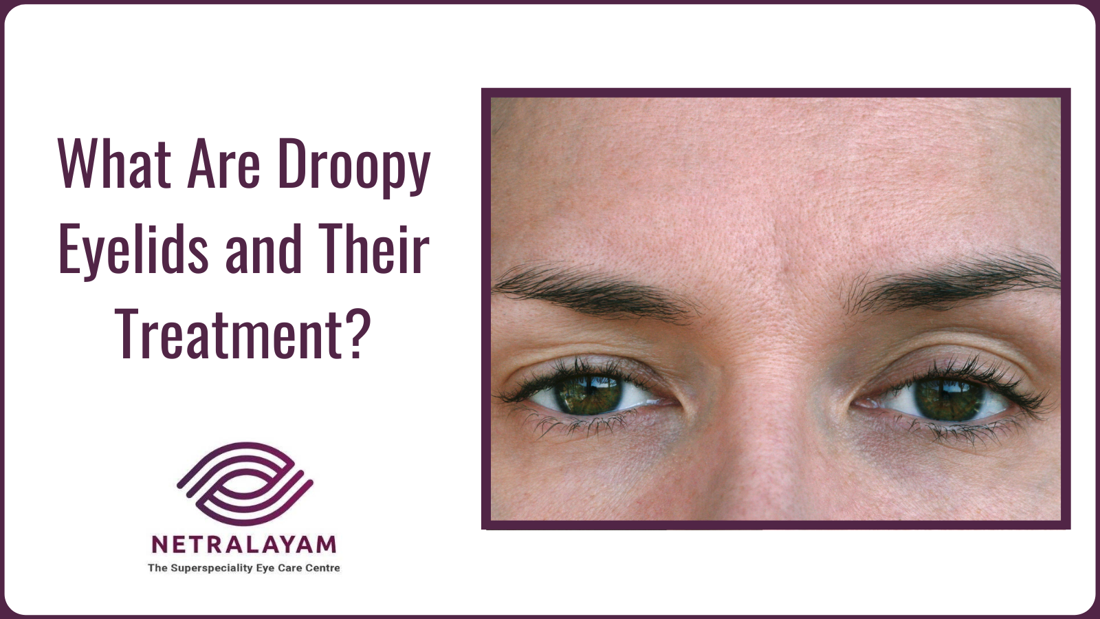 What Are Droopy Eyelids and Their Treatment?