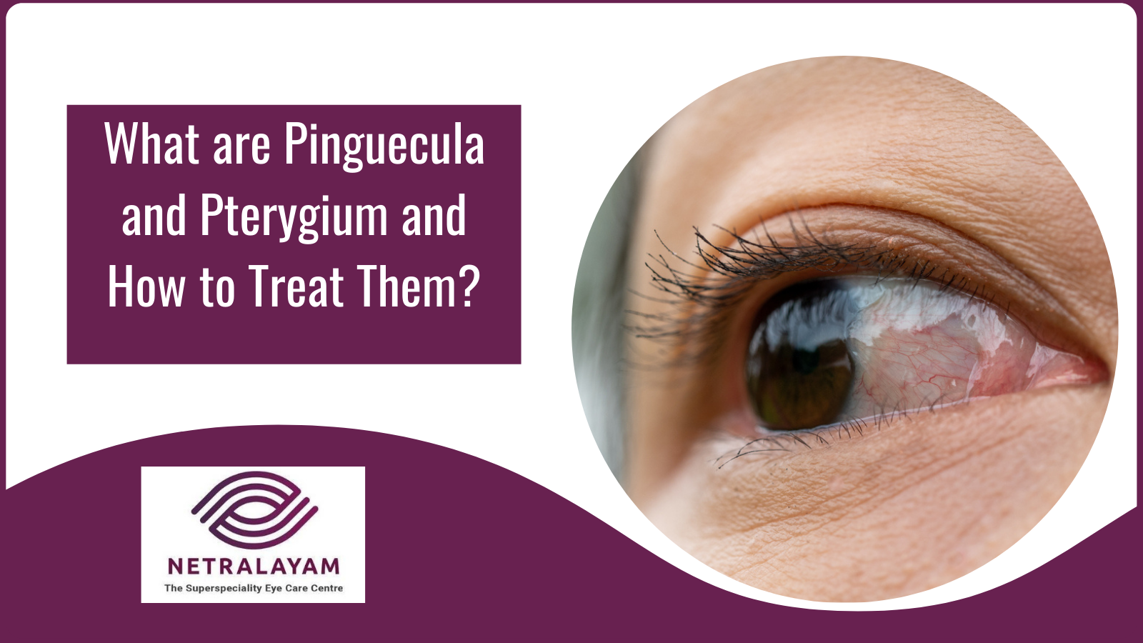 What are Pinguecula and Pterygium and How to Treat Them?