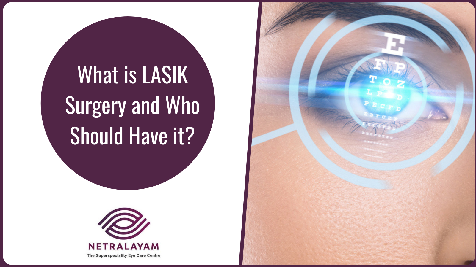 What is LASIK Surgery and Who Should Have it?