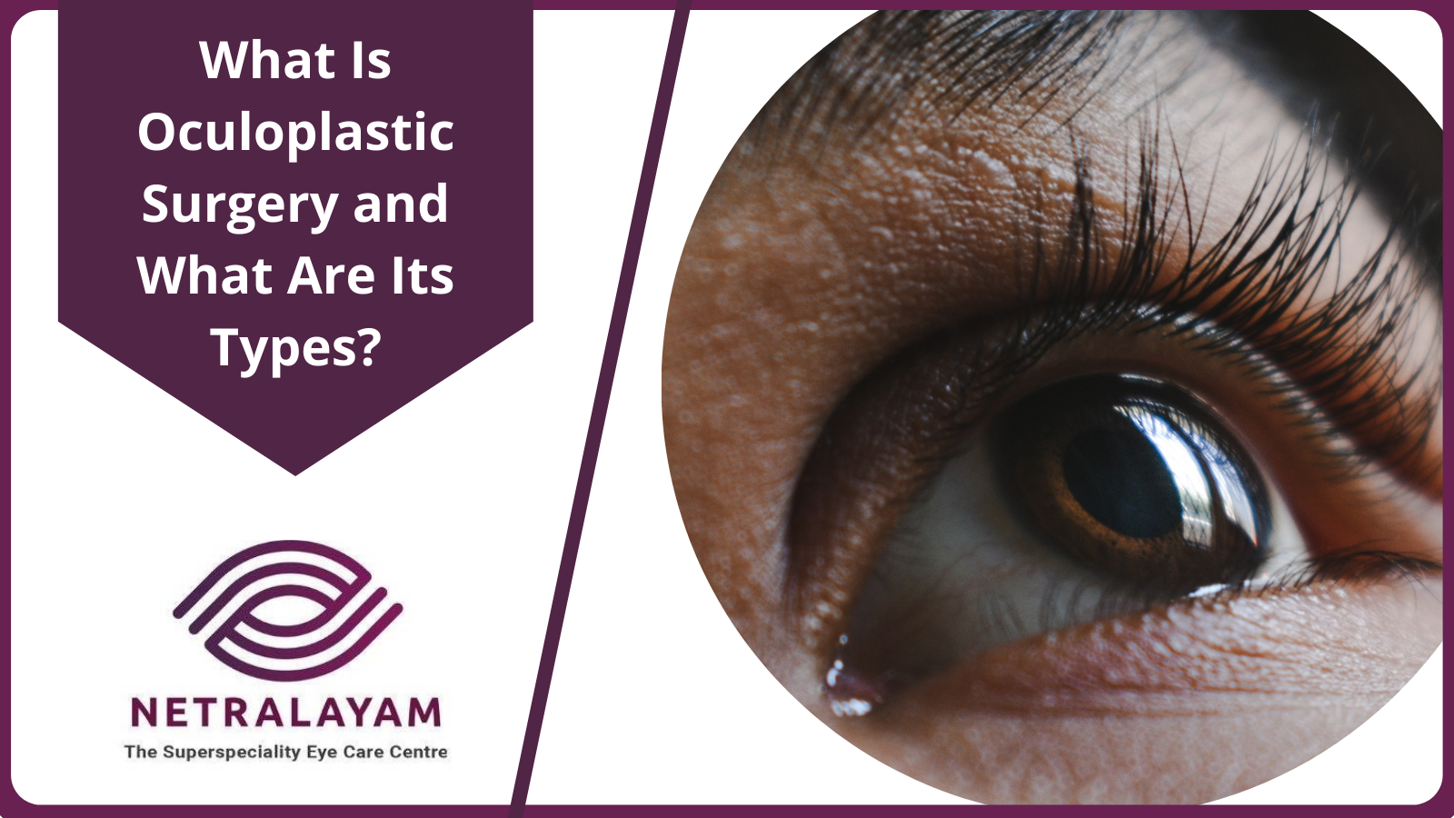 What Is Oculoplastic Surgery and What Are Its Types?