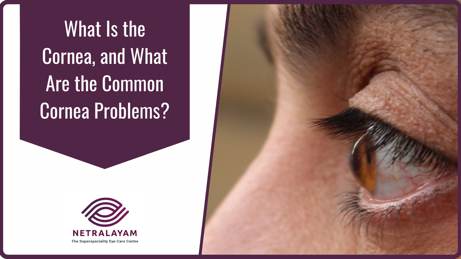 What Is the Cornea, and What Are the Common Cornea Problems?