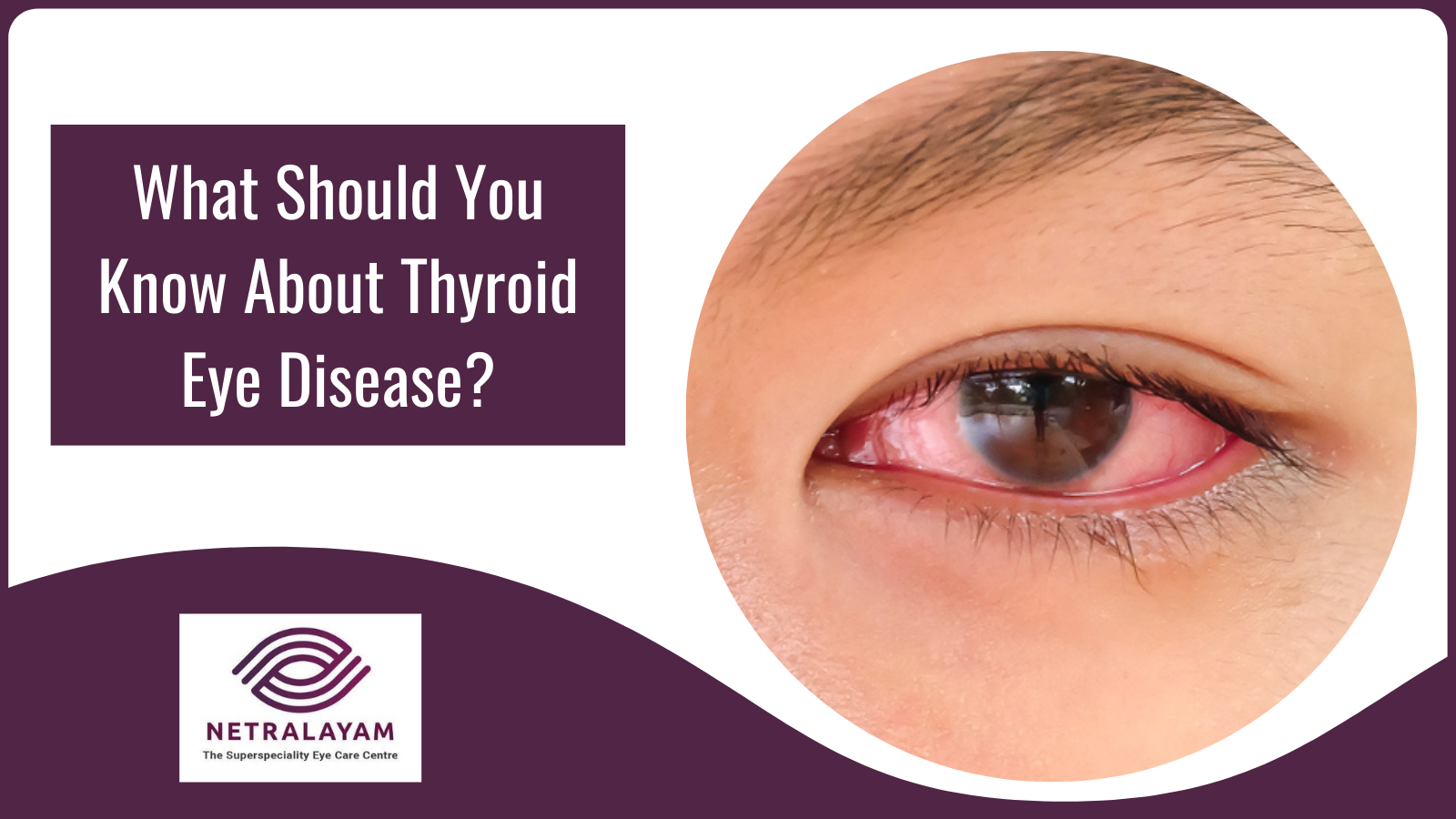 What Should You Know About Thyroid Eye Disease?