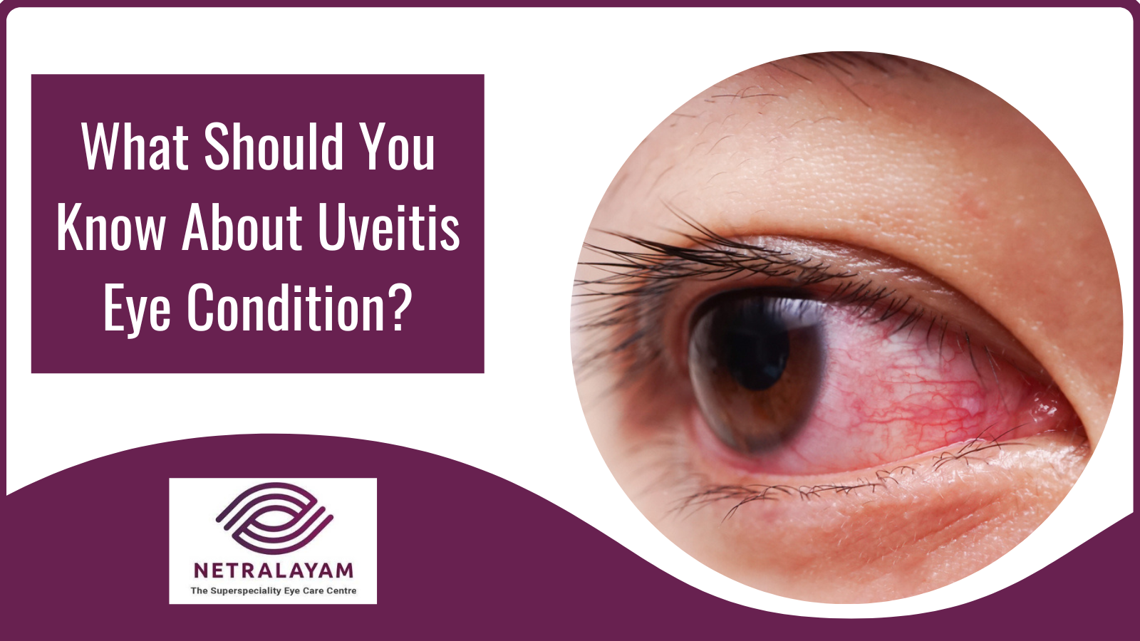 What Should You Know About Uveitis Eye Condition?