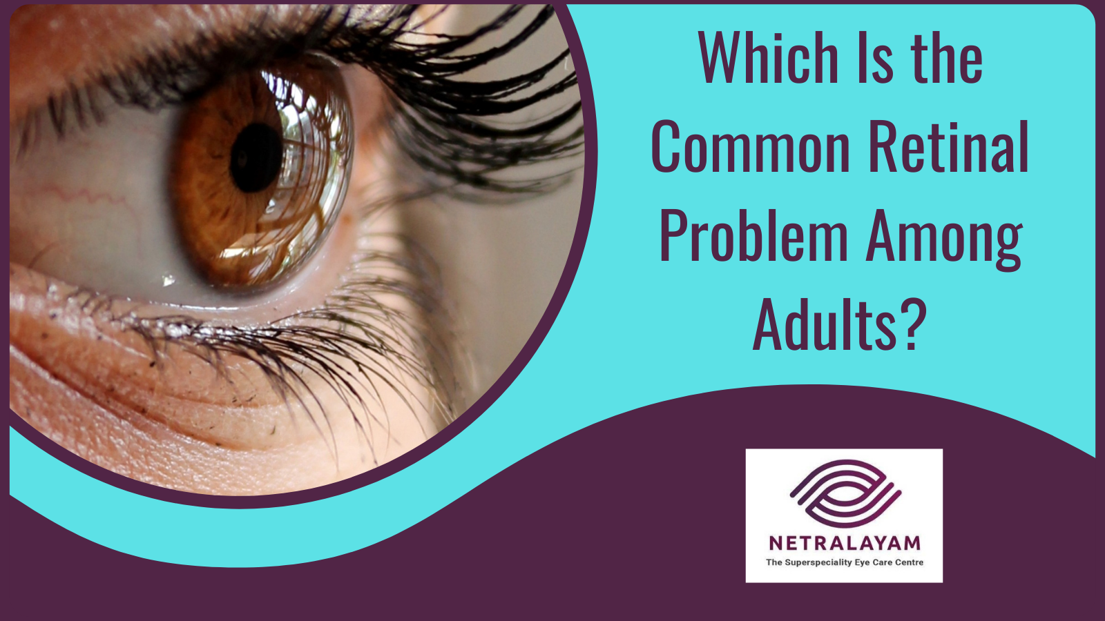 Which Is the Common Retinal Problem Among Adults?